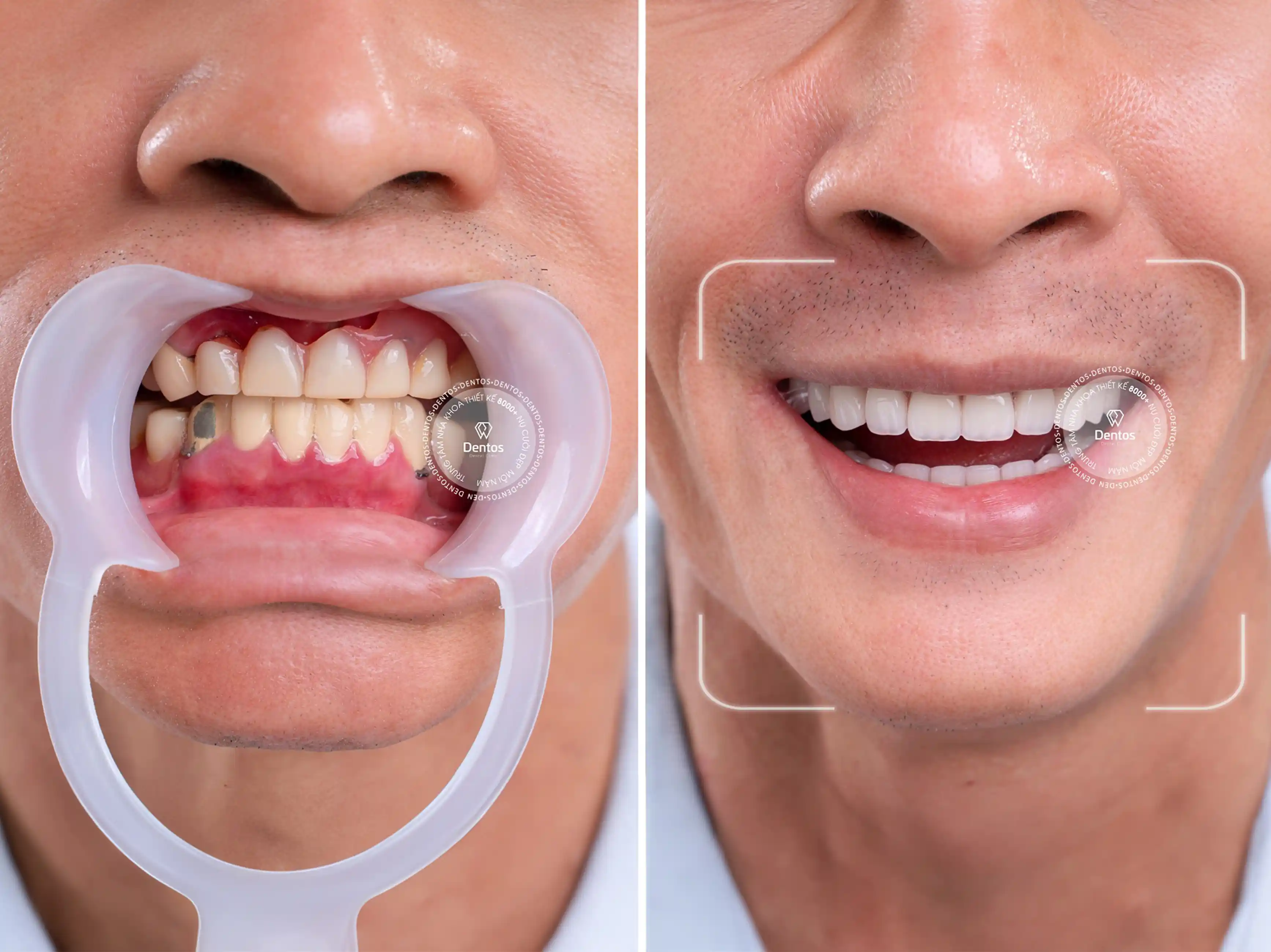 Nha khoa Dentos - Địa chỉ cấy ghép Implant uy tín tại TP.HCM